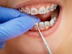 Smile Confidently: How Orthodontic Treatment in Alexandria Can Boost Your Self-Esteem